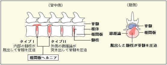 椎間板ヘルニアの説明図
